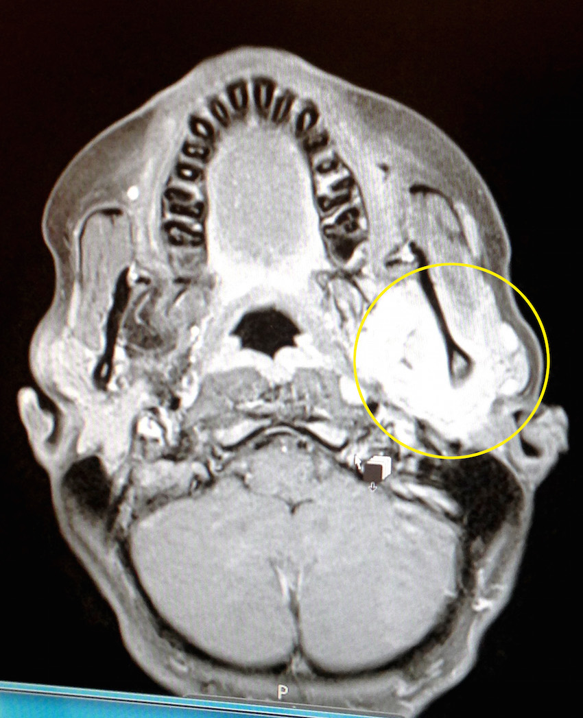 WISDOM TOOTH CANCER