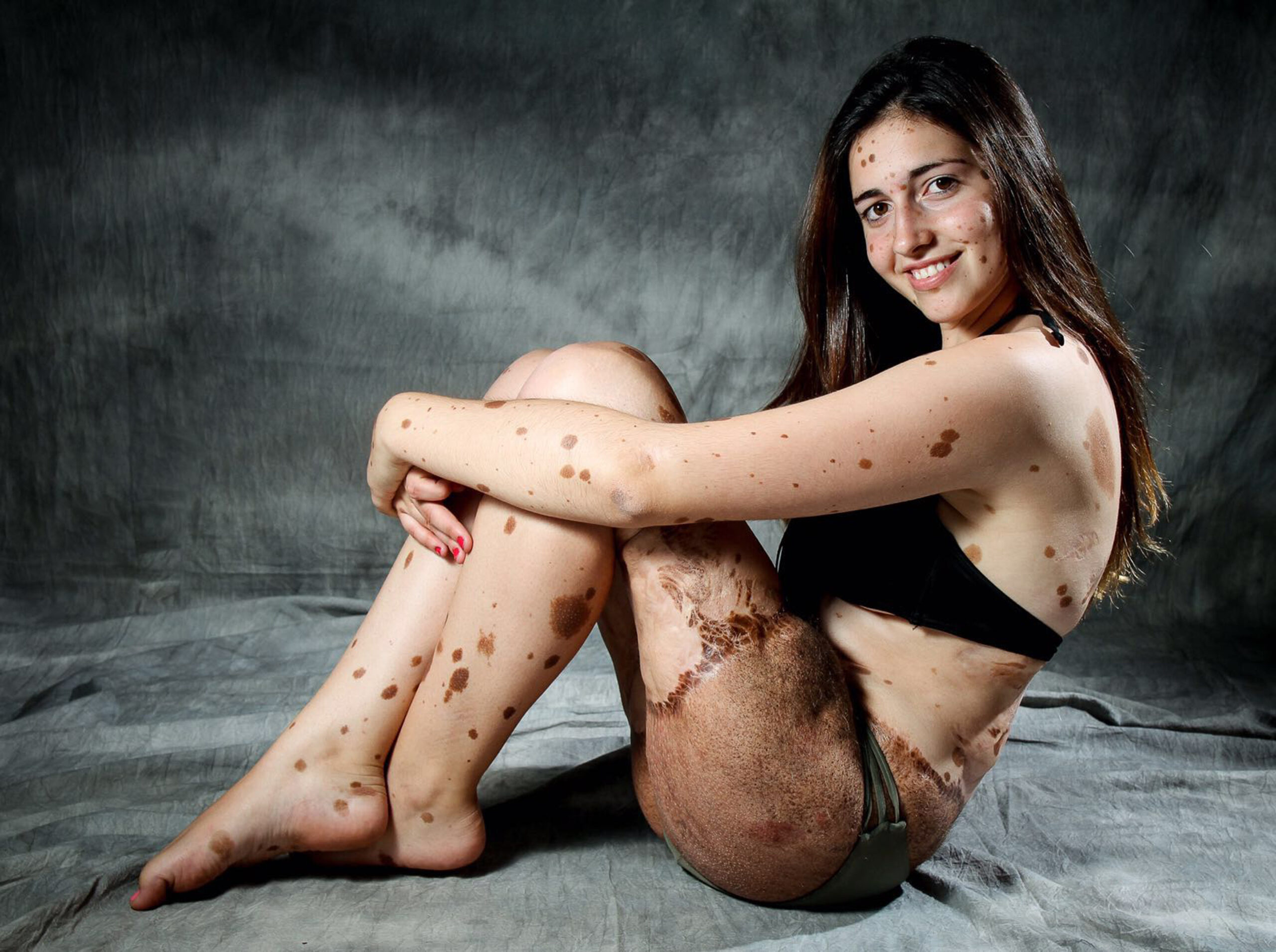 500 BIRTHMARKS GIRL NOW MODEL