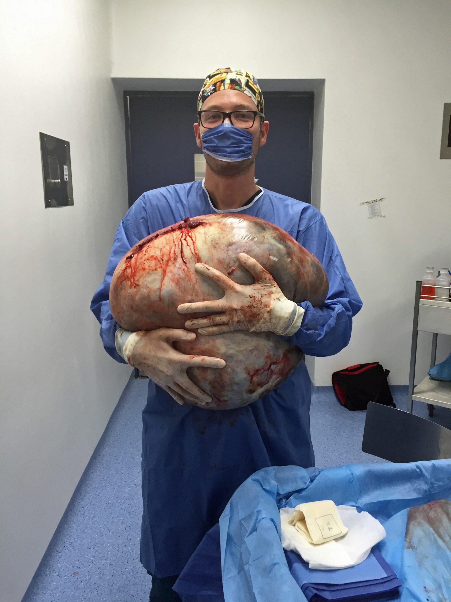 WORLD BIGGEST CYST REMOVED WHOLE