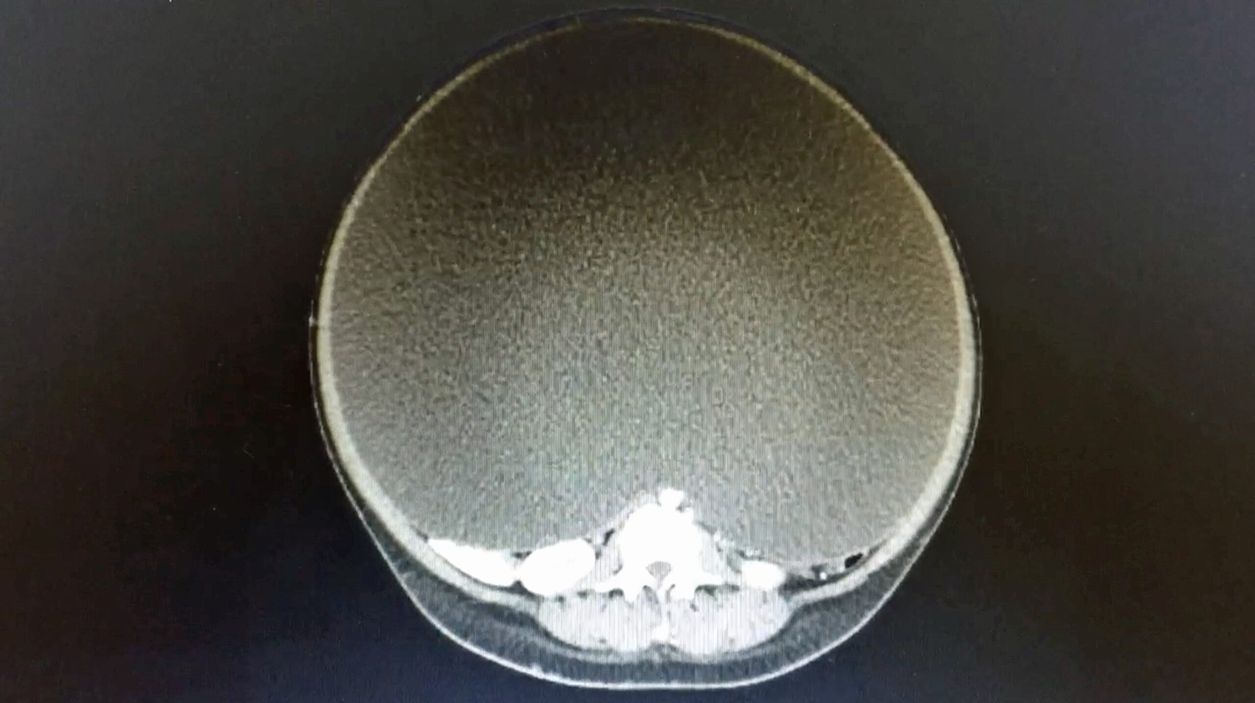 WORLD BIGGEST CYST REMOVED WHOLE