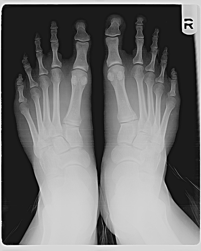 1024px-Mortons_toe_X-ray.jpg