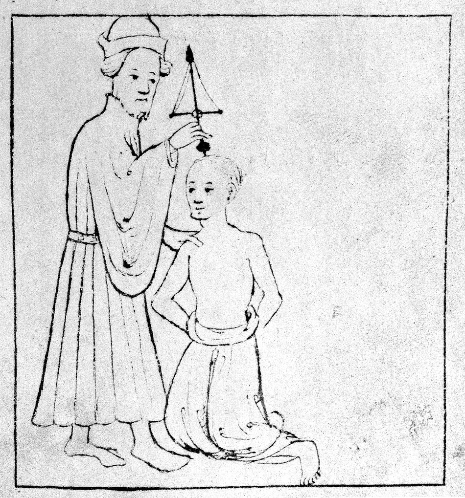 13th_century_trepanation._Wellcome_M0010165.jpg