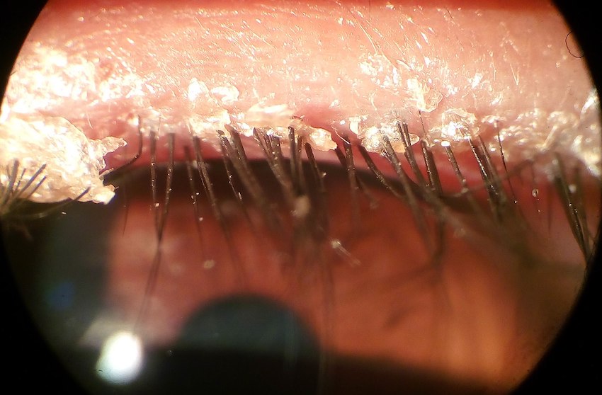 1600px-Anterior_Blepharitis.jpg