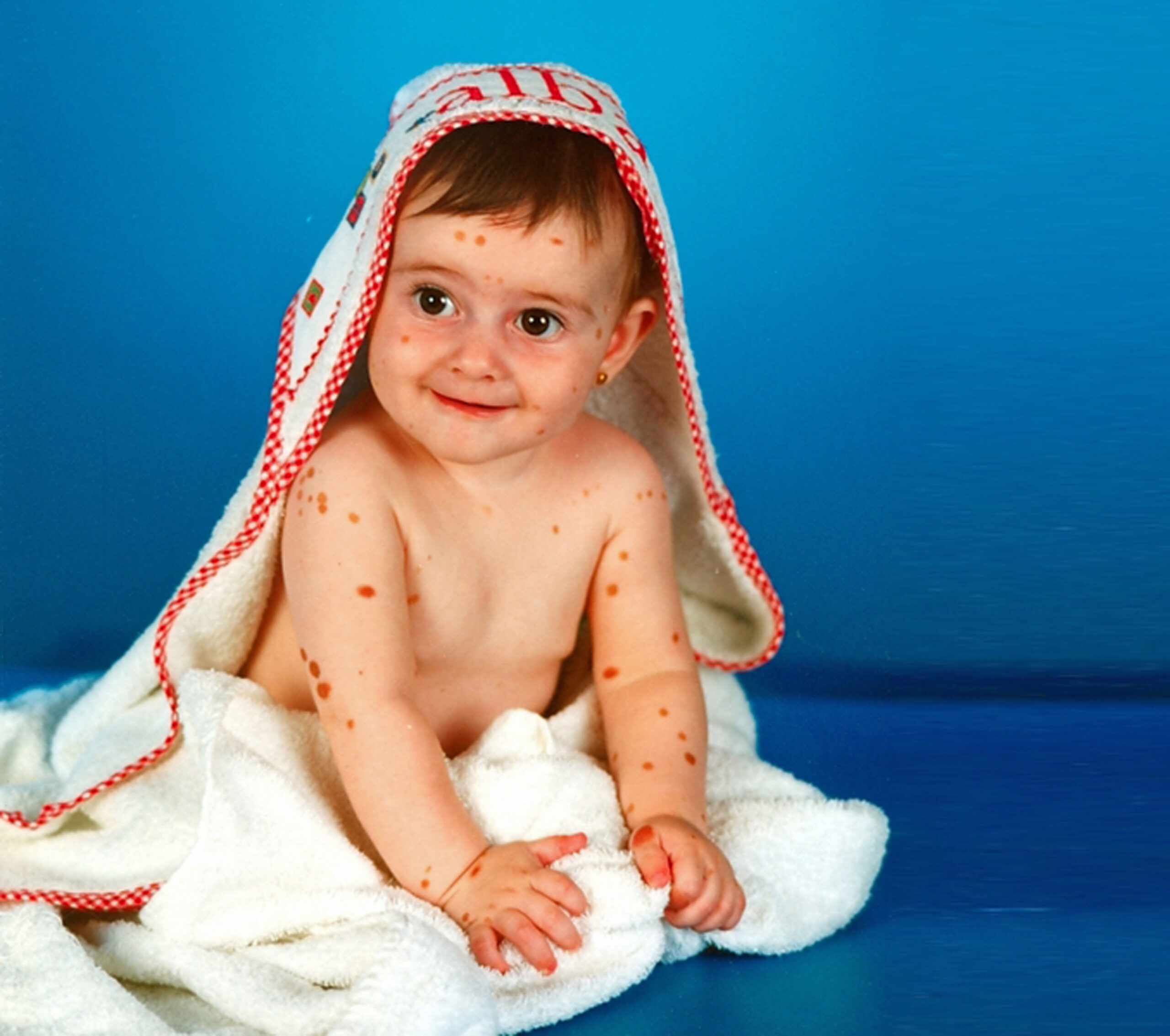 500 BIRTHMARKS GIRL NOW MODEL