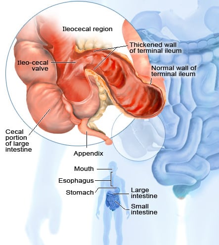 2011-crohns-disease.jpg