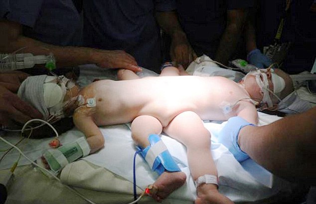 Yemeni Siamese Twins Successfully Separated