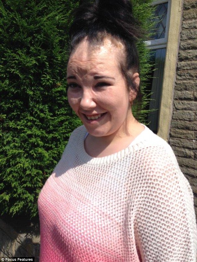 2A3382B100000578-3148734-The_teenager_has_found_courage_from_the_example_of_Katie_Piper_a-a-1_1436167288640.jpg