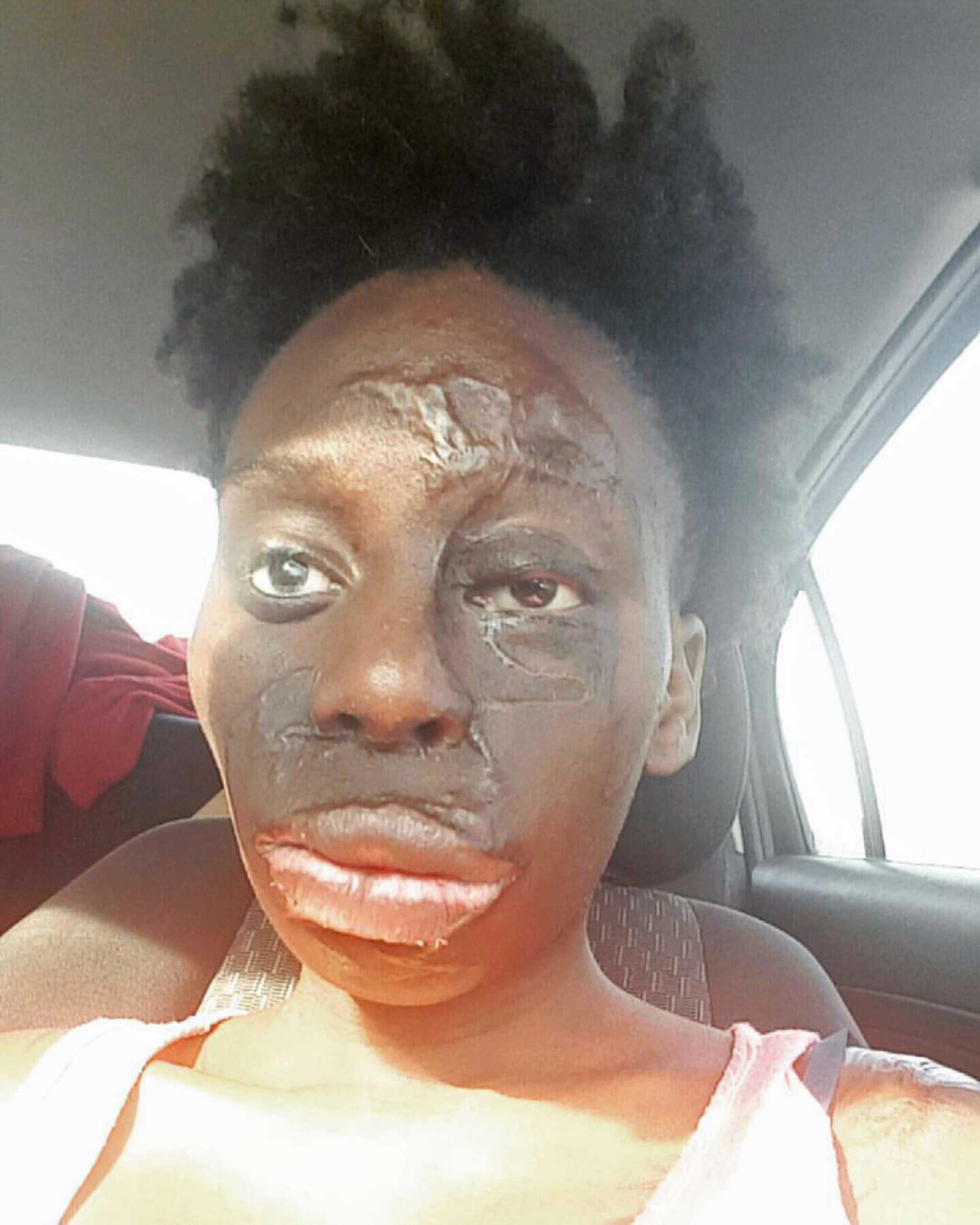 MONSTER BURNS VICTIM LOVES SCARS