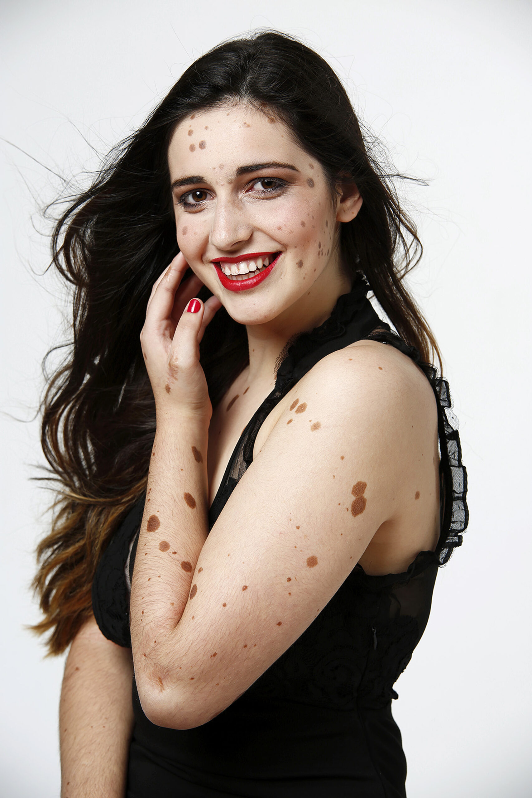 500 BIRTHMARKS GIRL NOW MODEL
