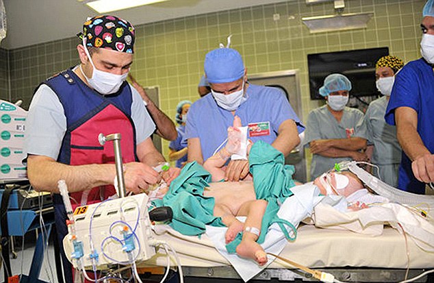 Yemeni Siamese Twins Successfully Separated