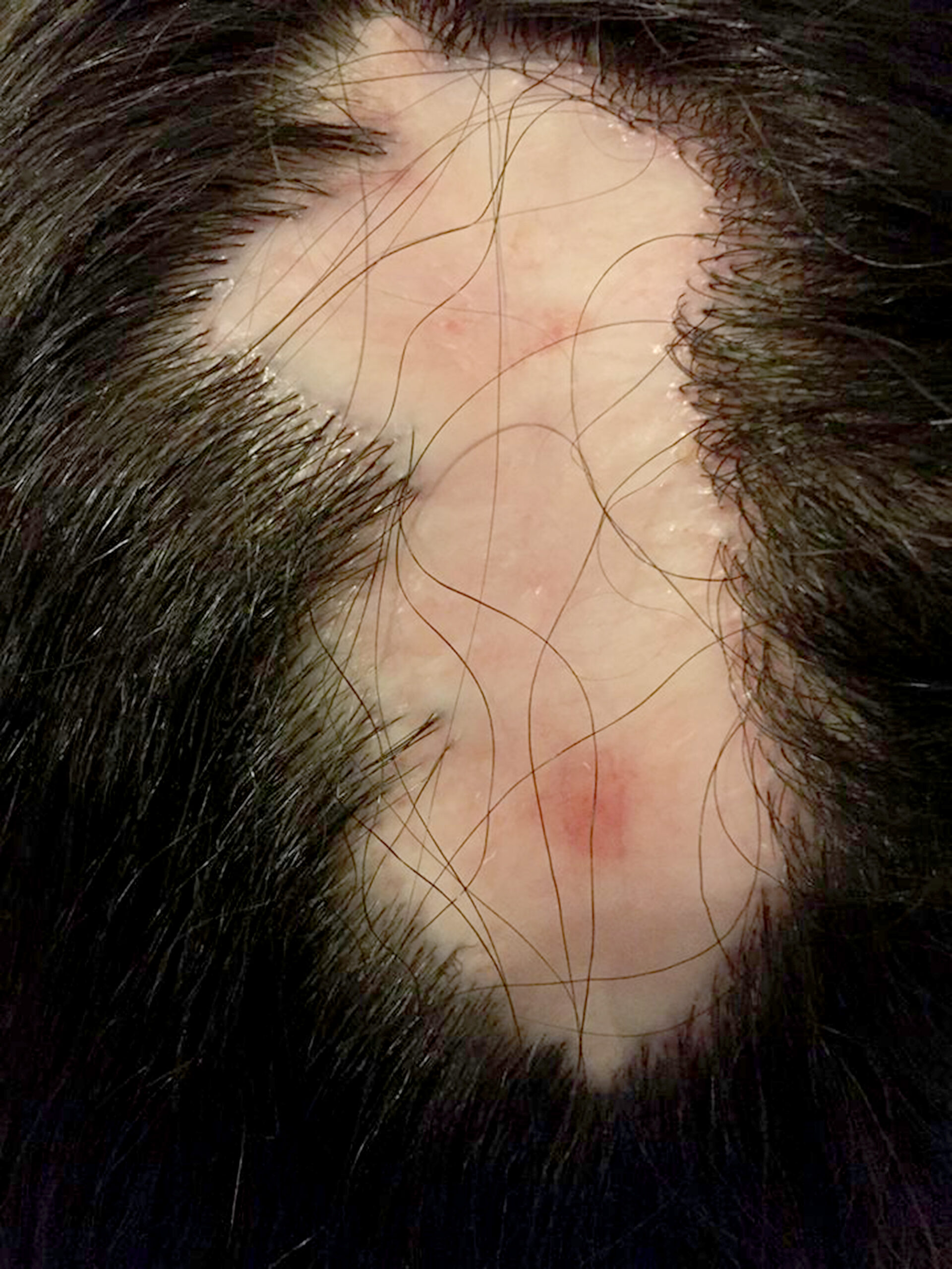 Bald hair dye burn