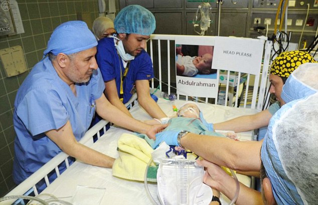 Yemeni Siamese Twins Successfully Separated