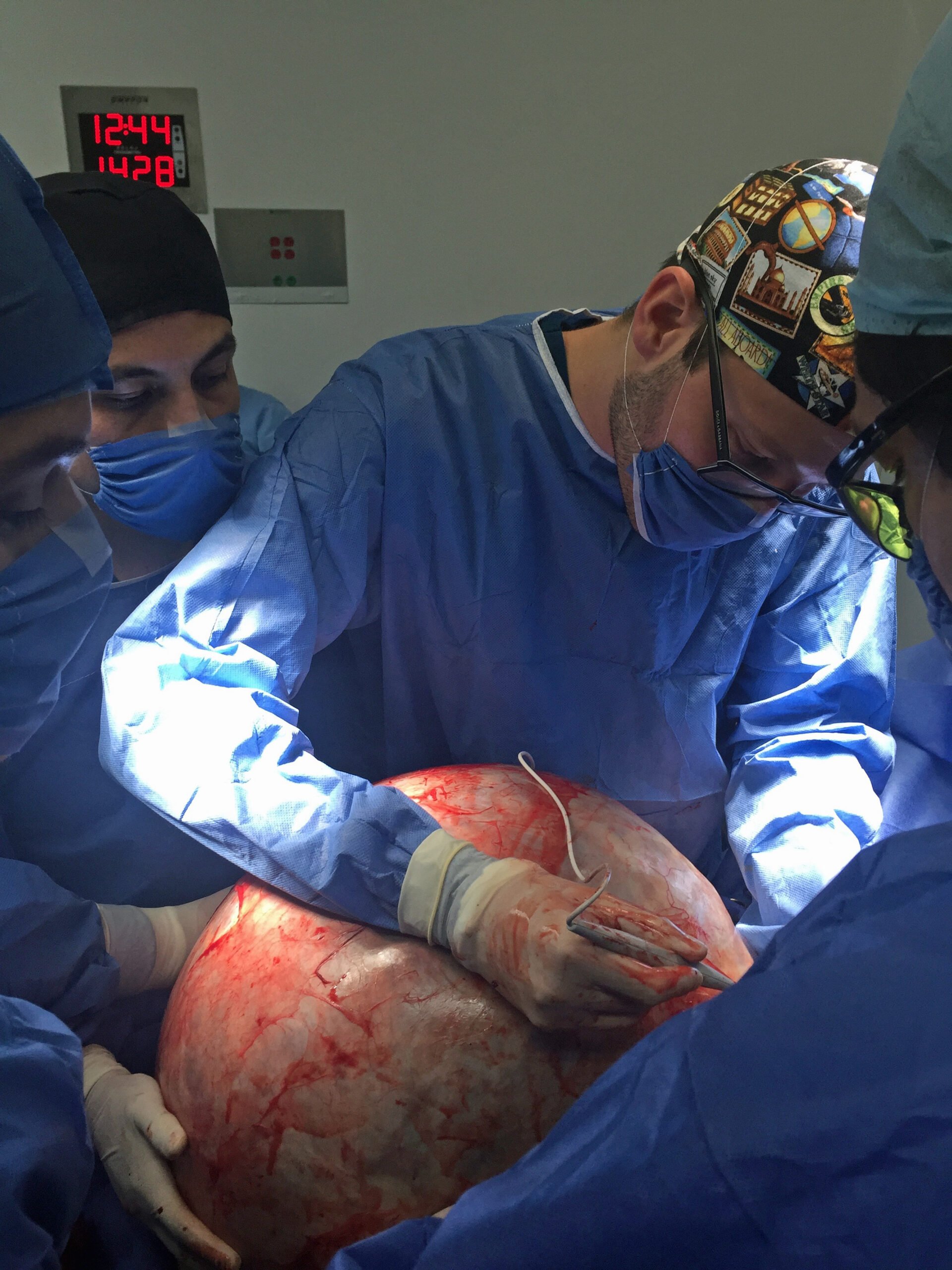 WORLD BIGGEST CYST REMOVED WHOLE
