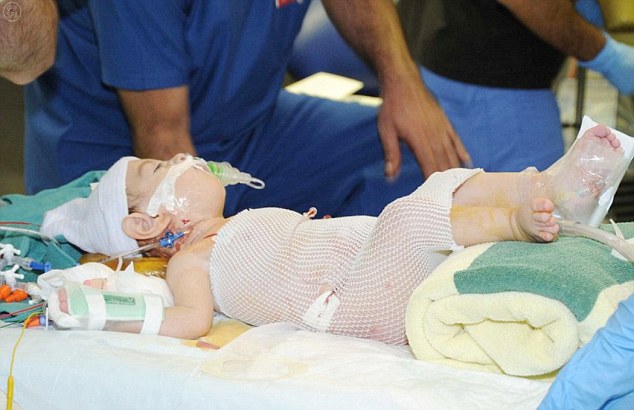 Yemeni Siamese Twins Successfully Separated