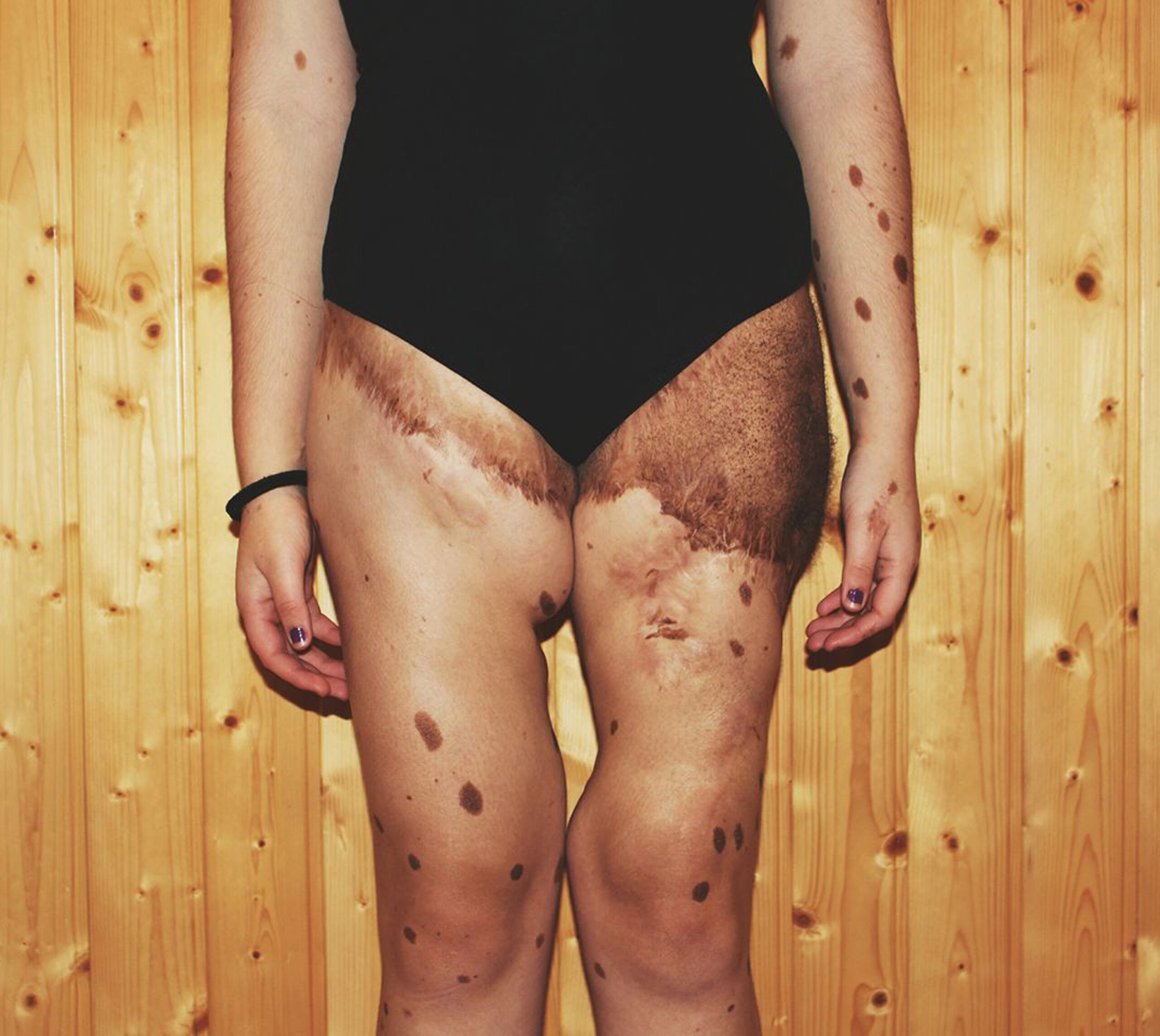 500 BIRTHMARKS GIRL NOW MODEL