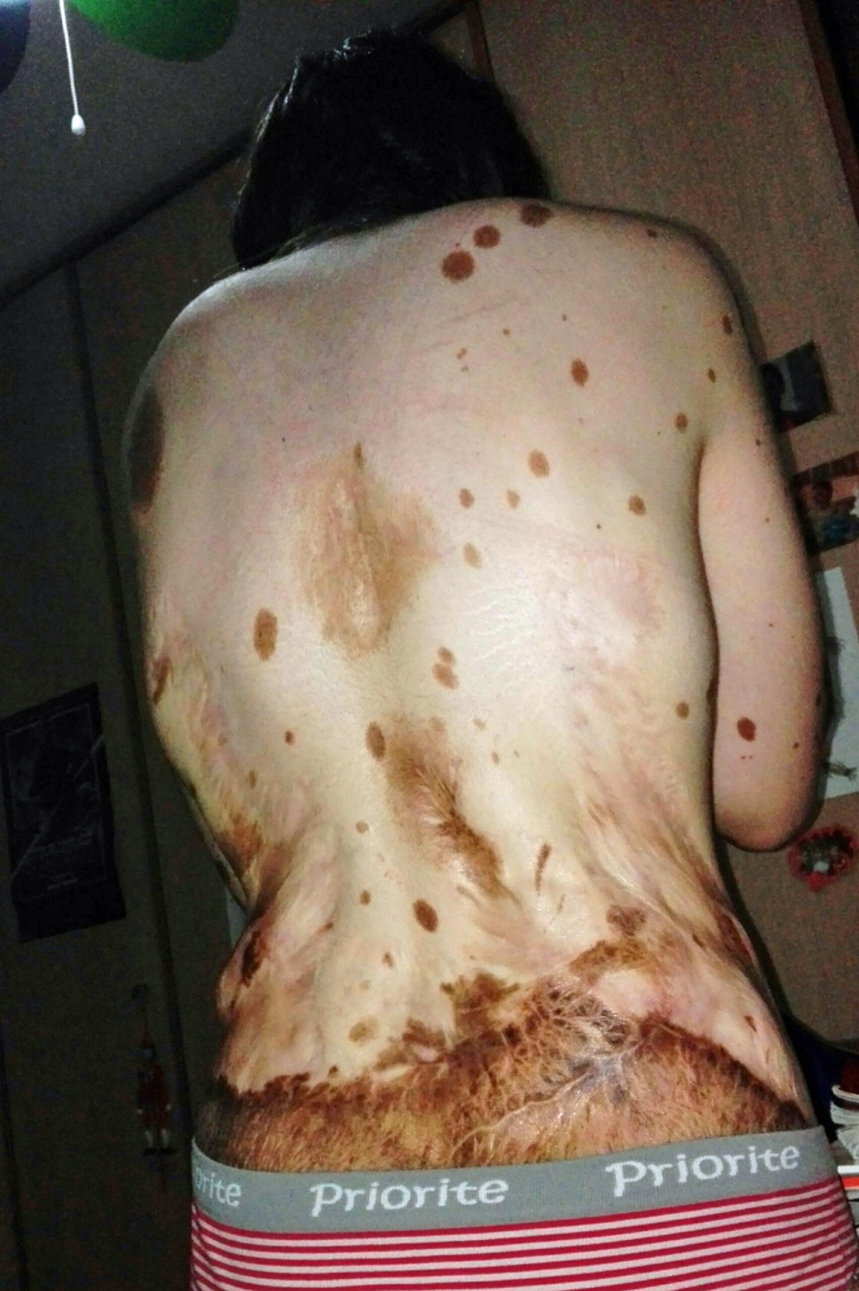 500 BIRTHMARKS GIRL NOW MODEL