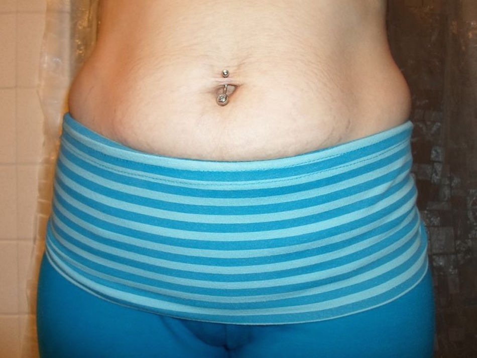 800px-Female_Torso_with_Tiger_Stripes_Stretch_Marks_from_Pregnancy.jpg
