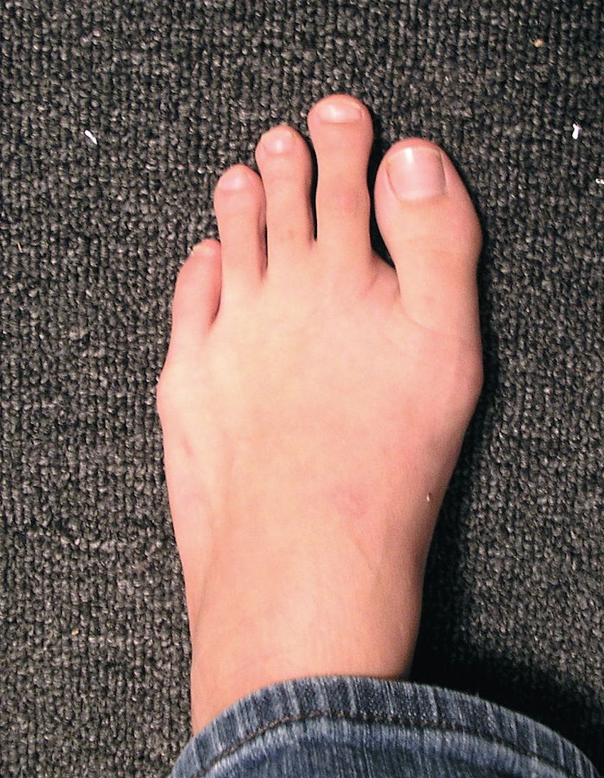 800px-Mortons_Toe.jpg