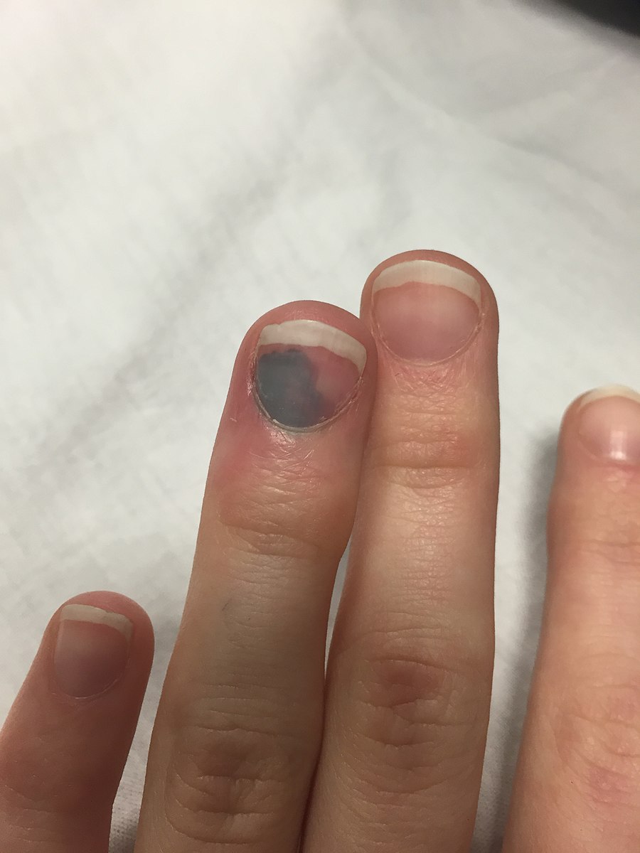 900px-Subungal_hematoma_of_the_finger.jpg