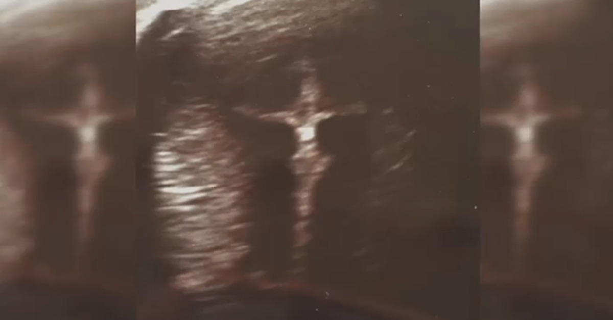 A ultrasound