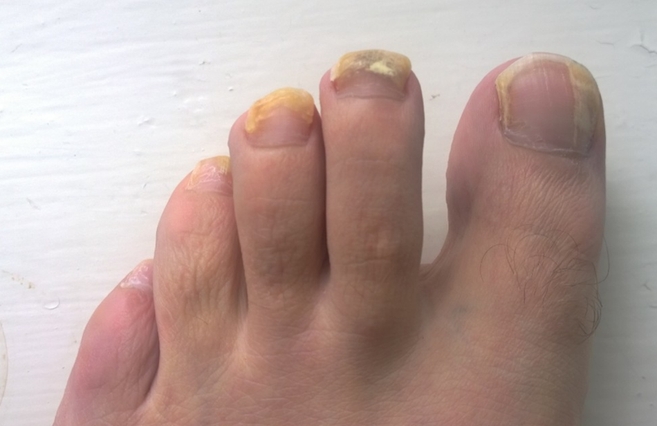 A_patients_left_foot_-_after_ten_weeks_of_Terbinafine_oral_treatment.png A_patients_left_foot_-_after_ten_weeks_of_Terbinafine_oral_treatment.png
