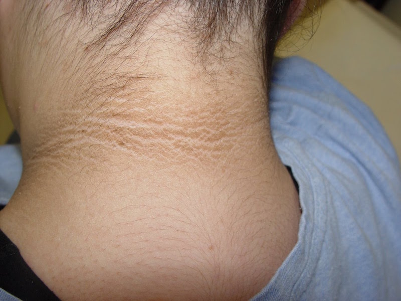 Acanthosis-Nigricans-DermTV.com-Epi-452.jpg