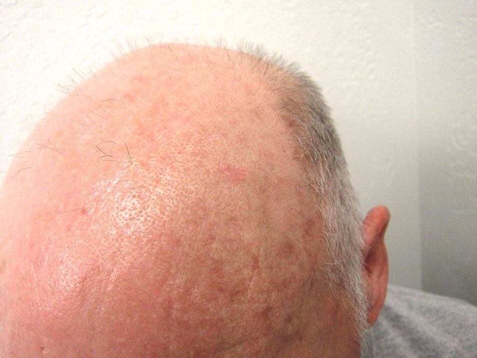 Actinic_keratosis_on_balding_head.jpg