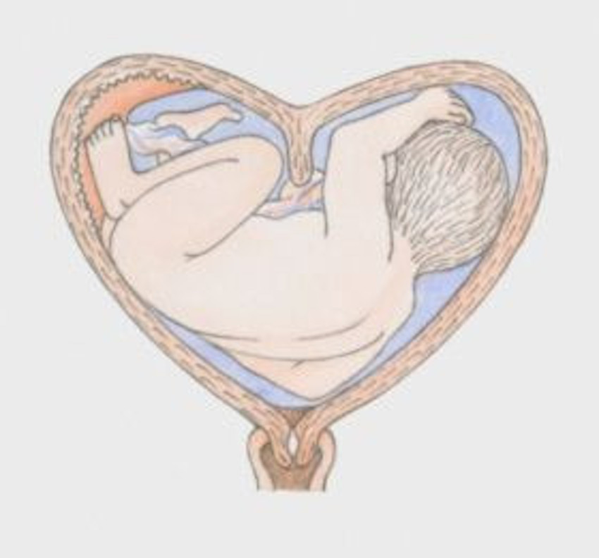 Bicornuate-uterus-with-baby.jpg