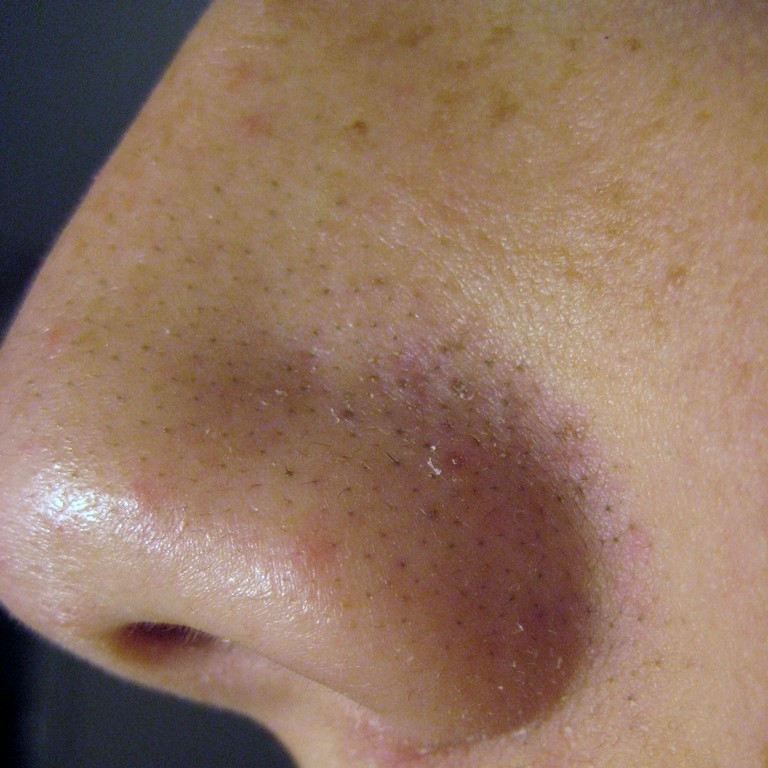 Blackheads-1.jpg