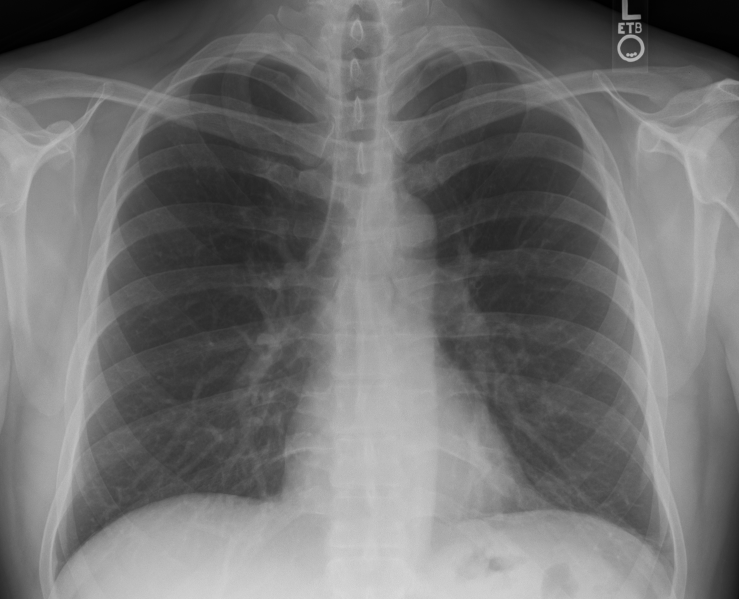 Chest_Xray_PA_3-8-2010.png