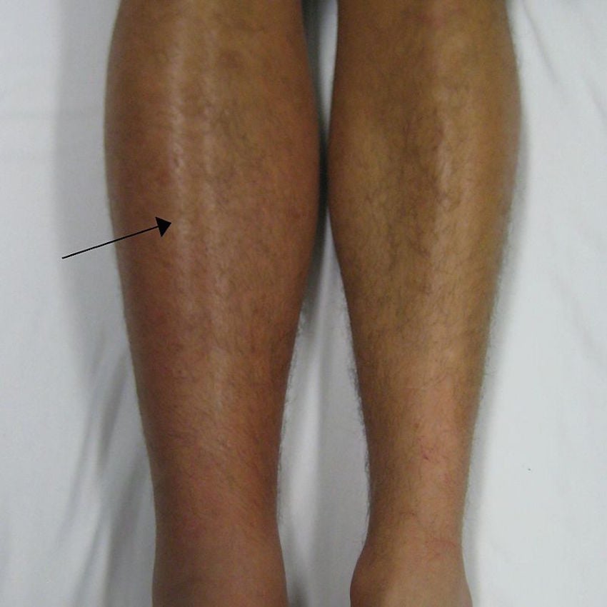 Deep_vein_thrombosis_of_the_right_leg.jpg Deep_vein_thrombosis_of_the_right_leg.jpg