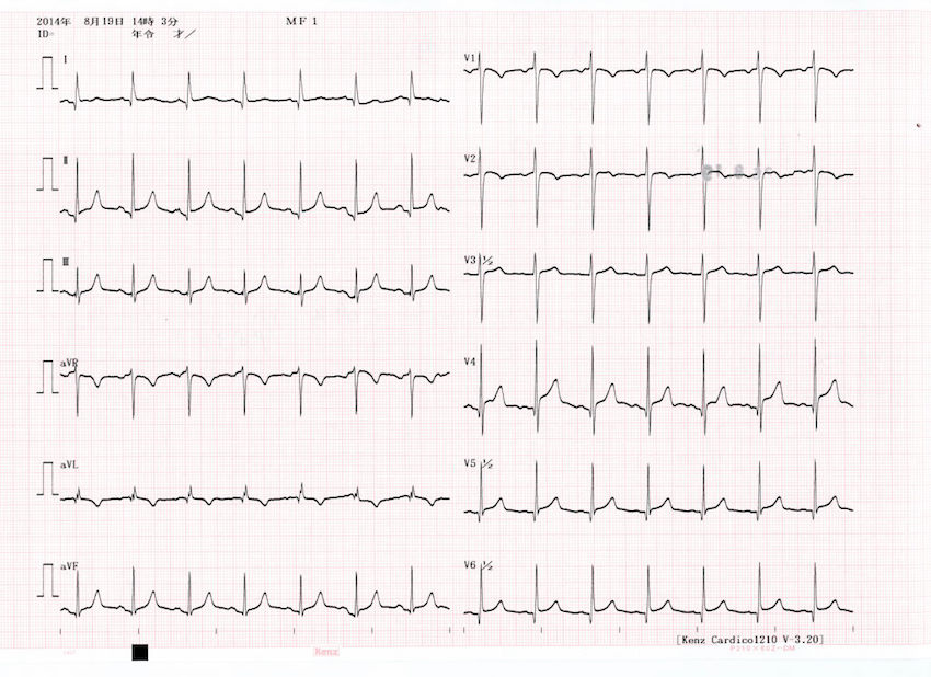 ECG_of_Takotsubo_cardiomyopathy.jpg