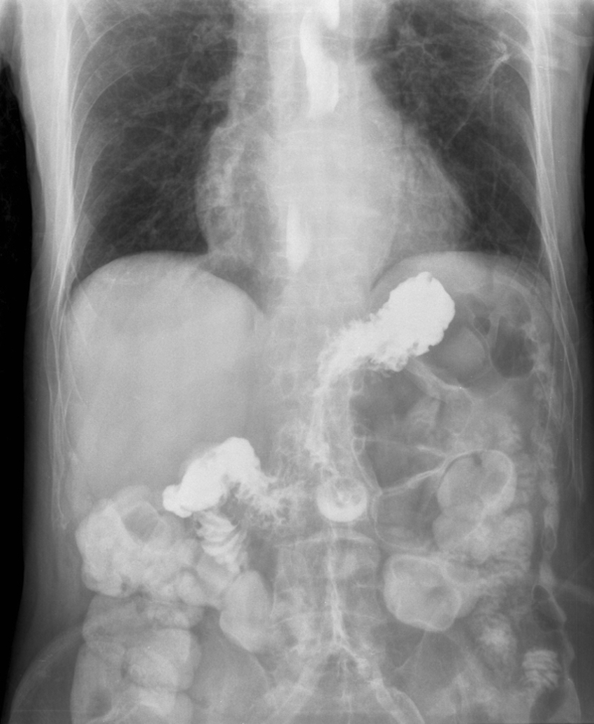 Gastroesophageal_reflux_barium_X-ray.jpg