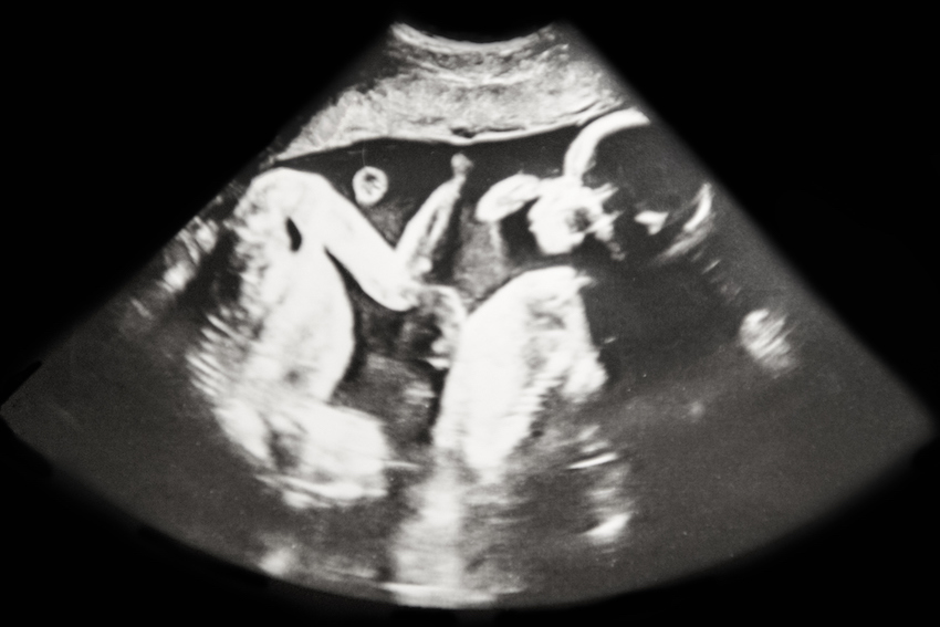 Baby Ultrasound Identical Twins