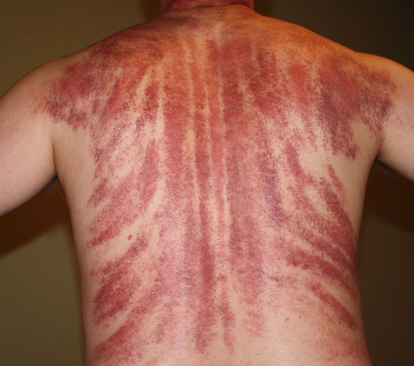 Gua_Sha_Massage_Aftermath.jpg