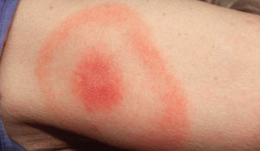 Lyme_Disease_300x174_C0031417.jpg