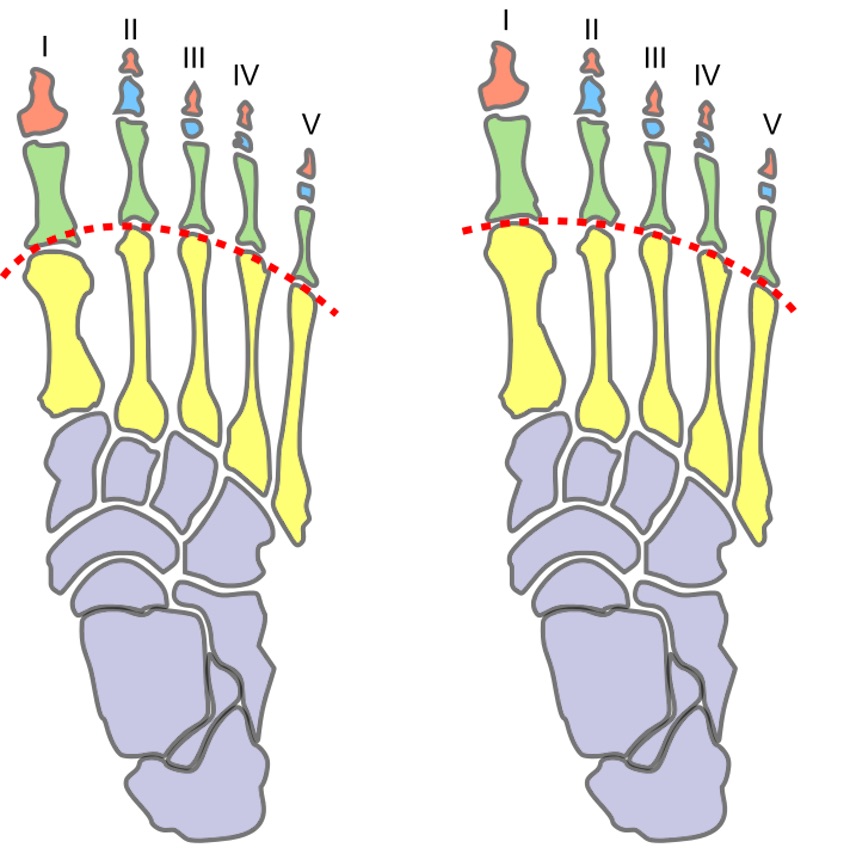 Mortons_foot_comparison.jpg