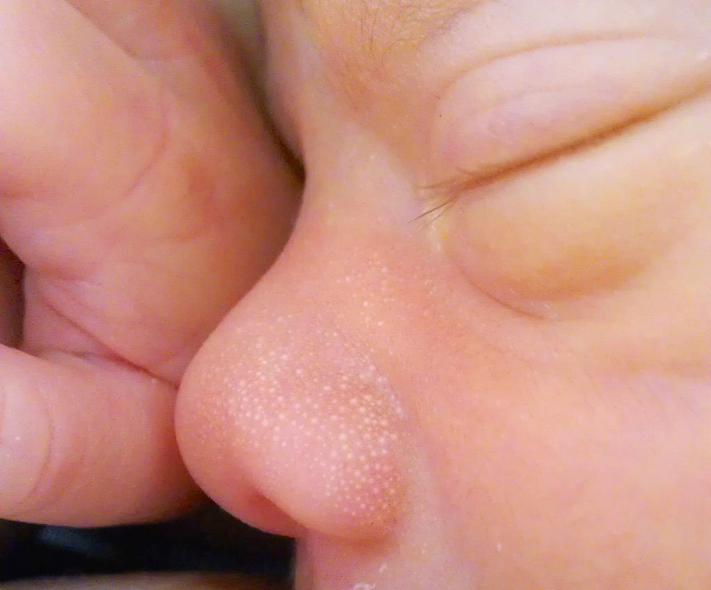 Newborn_Milia_Milk_Spots.jpg