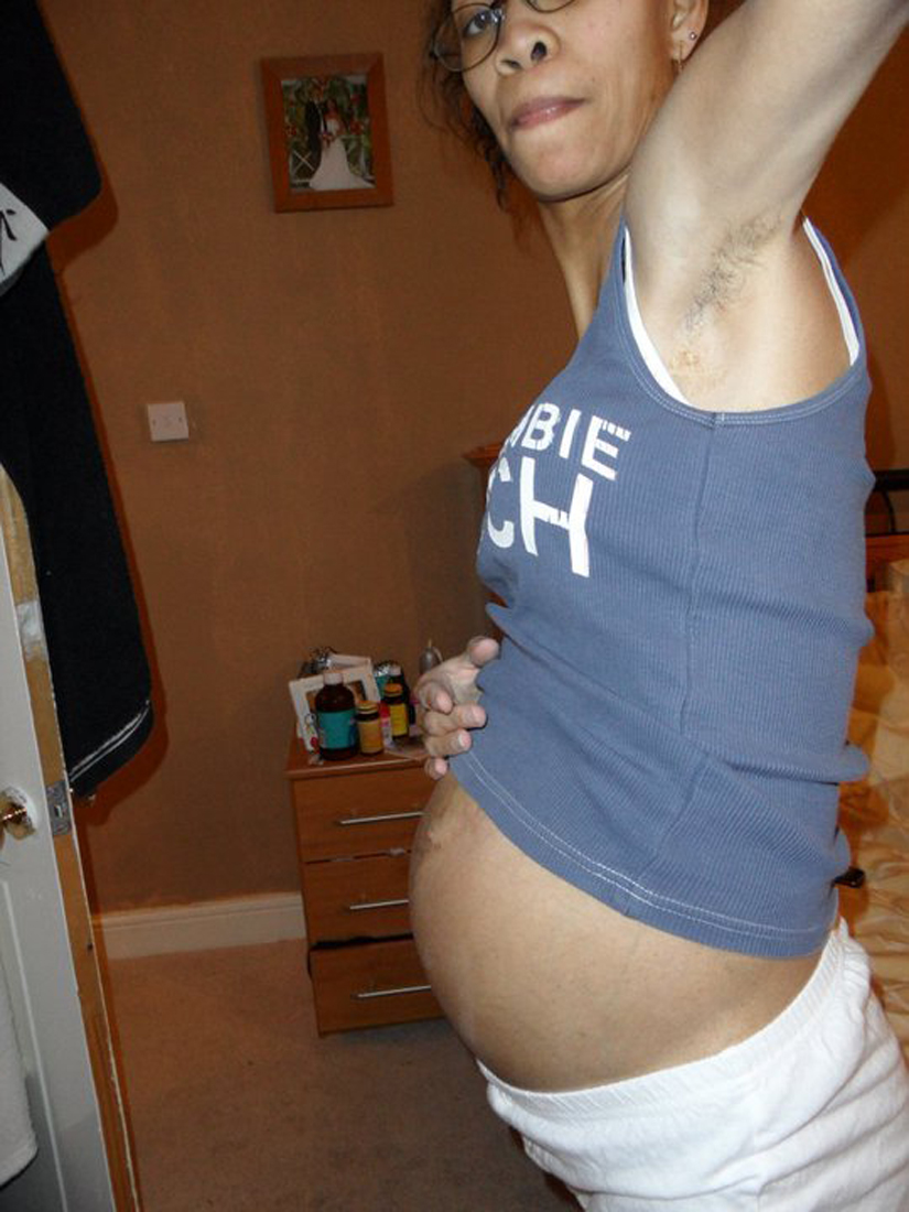 PA Real Life - Claire Wright - Uterus Didelphys