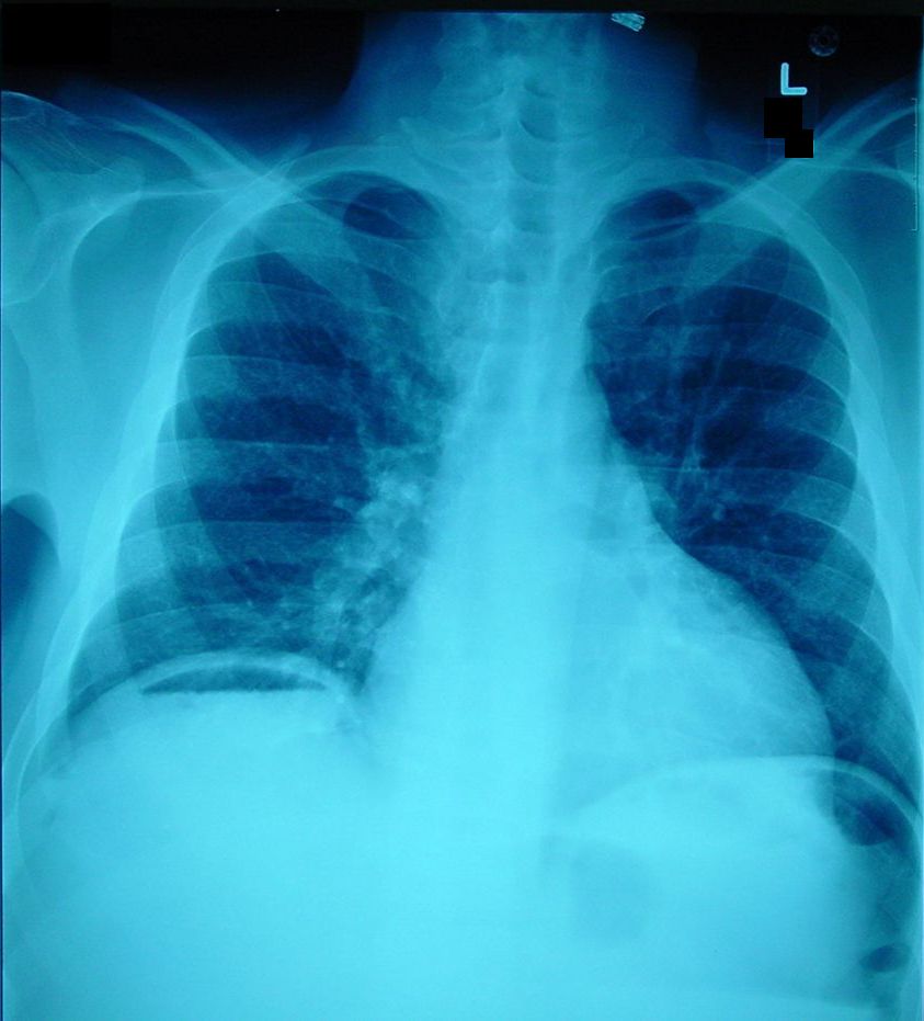 Pneumoperitoneum_X-ray.jpg