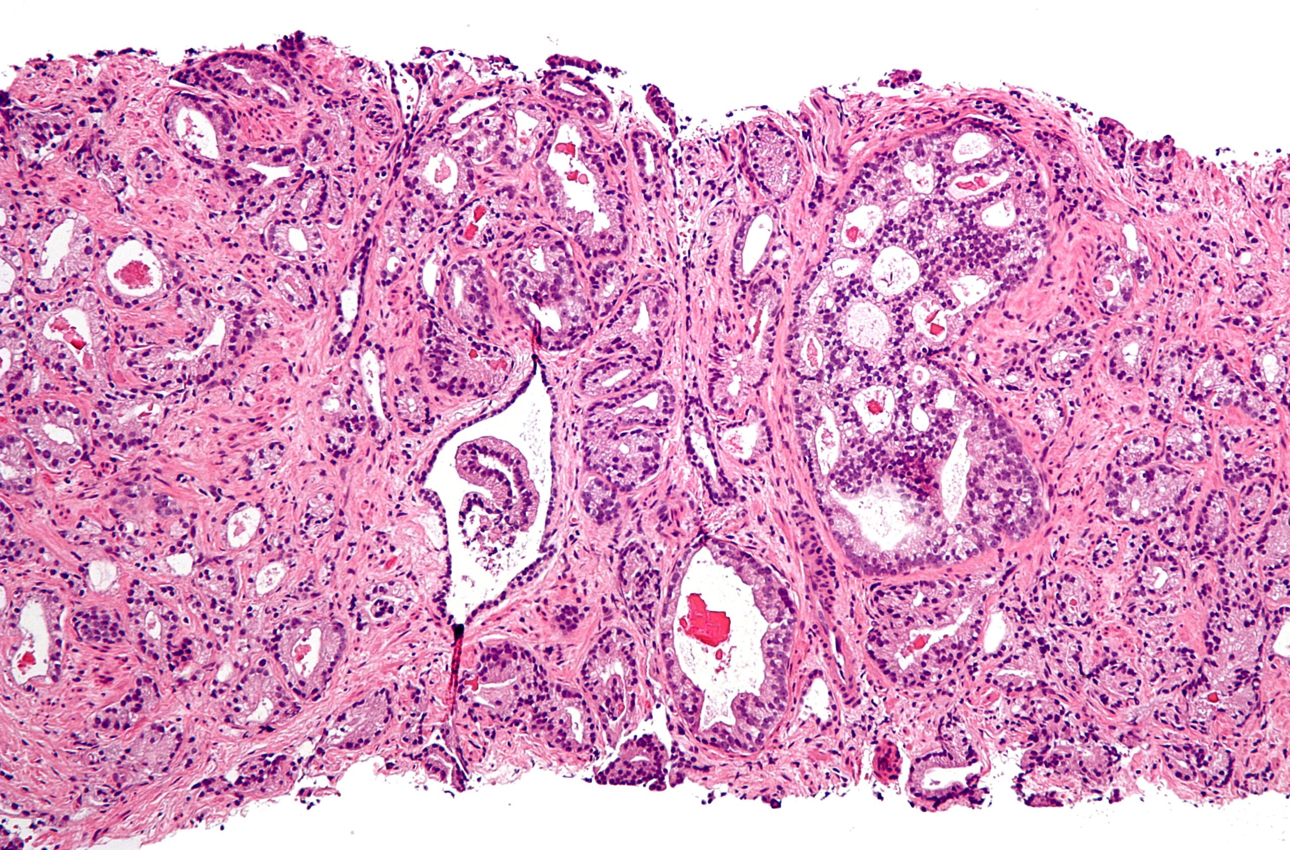 Prostate_cancer_with_Gleason_pattern_4_low_mag.jpg