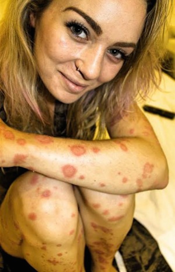 SWNS_TOTAL_PSORIASIS_01-e1440423876265.jpg