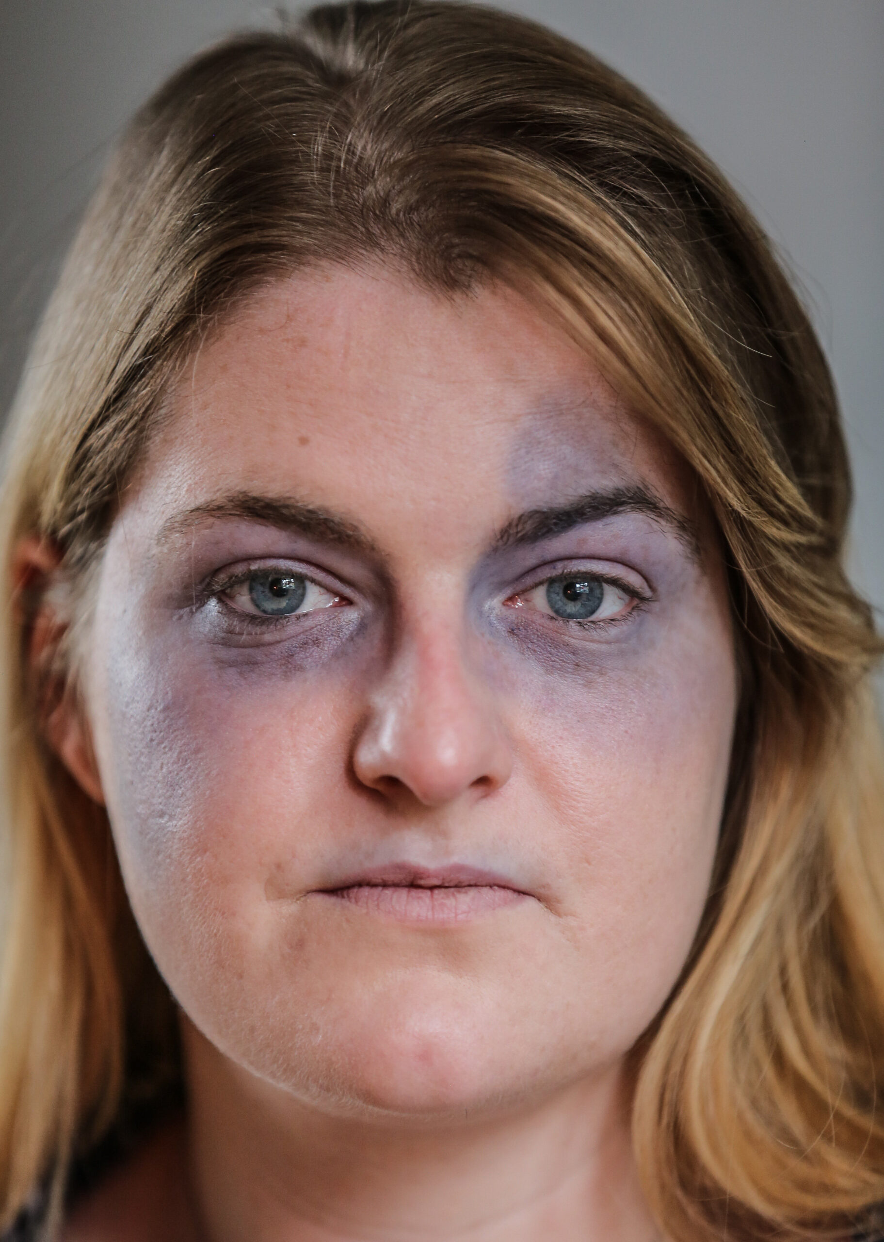 SWNS_UDEN_BRUISES_03.jpg SWNS_UDEN_BRUISES_03.jpg