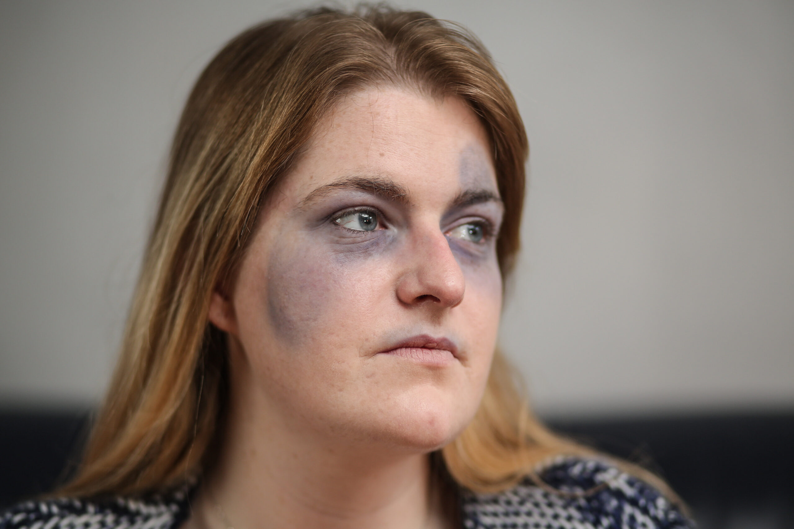 SWNS_UDEN_BRUISES_08.jpg SWNS_UDEN_BRUISES_08.jpg