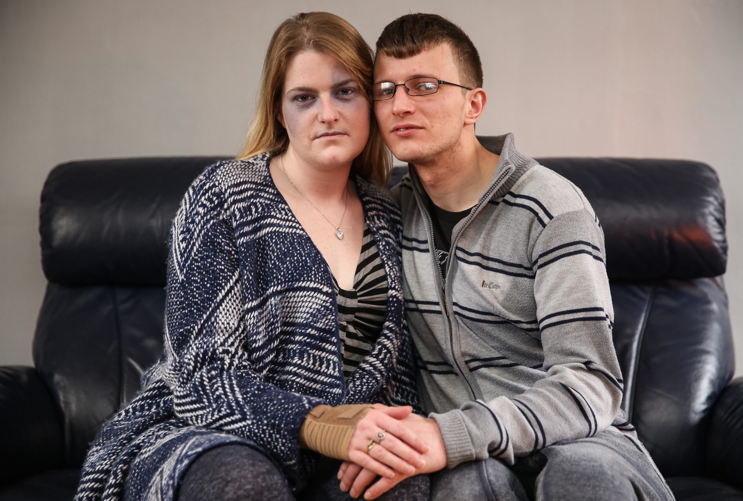 SWNS_UDEN_BRUISES_14.jpg SWNS_UDEN_BRUISES_14.jpg