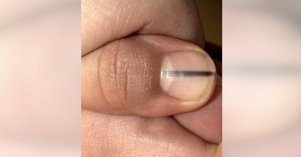 manicurist-nail-melanoma