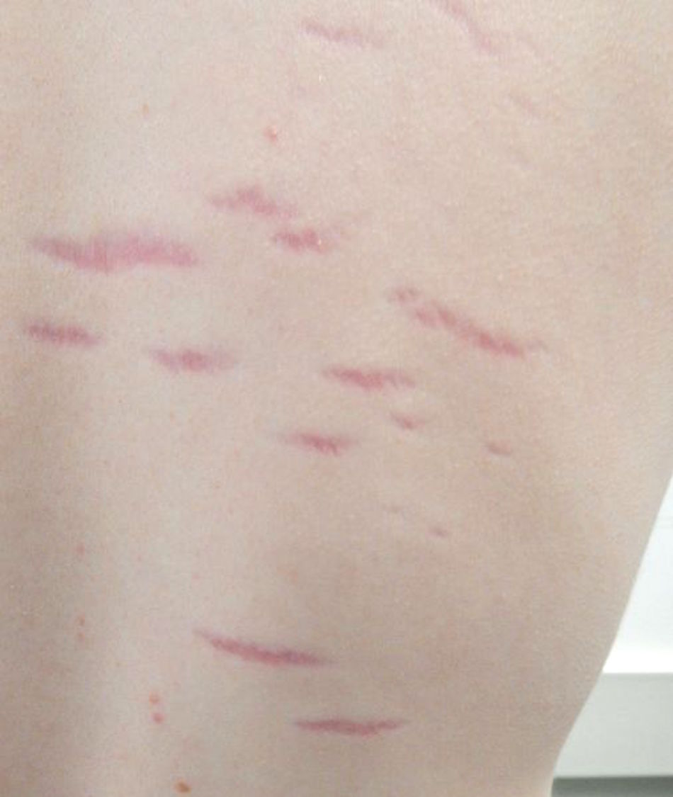 StretchMark.jpg