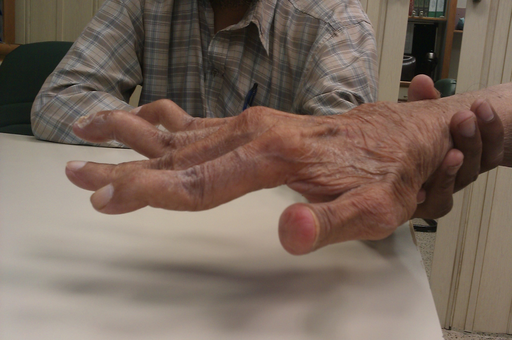 Swan_neck_deformity_in_a_65_year_old_Rheumatoid_Arthritis_patient-_2014-05-27_01-49.jpg