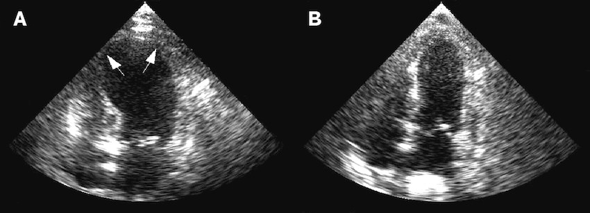 Takotsubo_ultrasound.gif