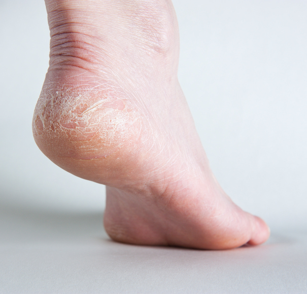 Cracked heel on human foot, side view.